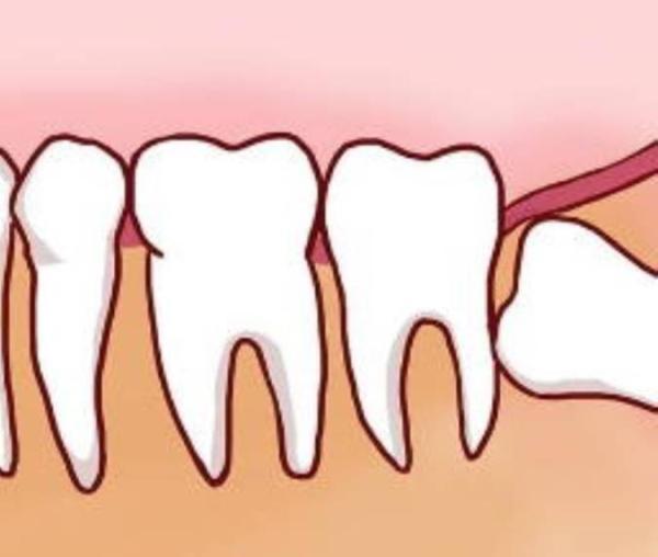 دندان عقل نهفته را چگونه جراحی می نمایند؟